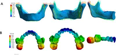 Biomechanical effects of different mandibular movements and torque compensations during mandibular advancement with clear aligners: a finite element analysis